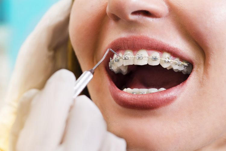 Daftar Harga Kawat Gigi dan Biaya Pemasangan Kawat Gigi