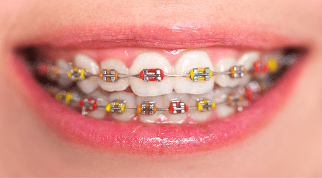 6 Jenis Behel  untuk Gigi Tonggos Keramik  Lingual 