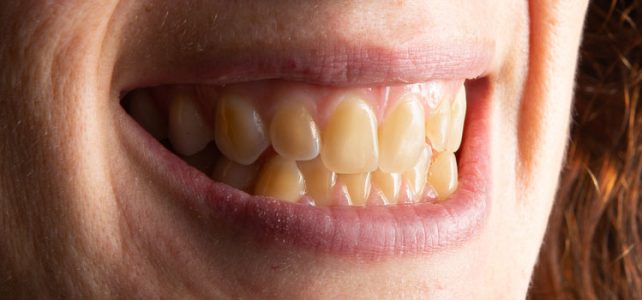 5 Cara Menghilangkan Gigi Kuning Yang Sudah Lama
