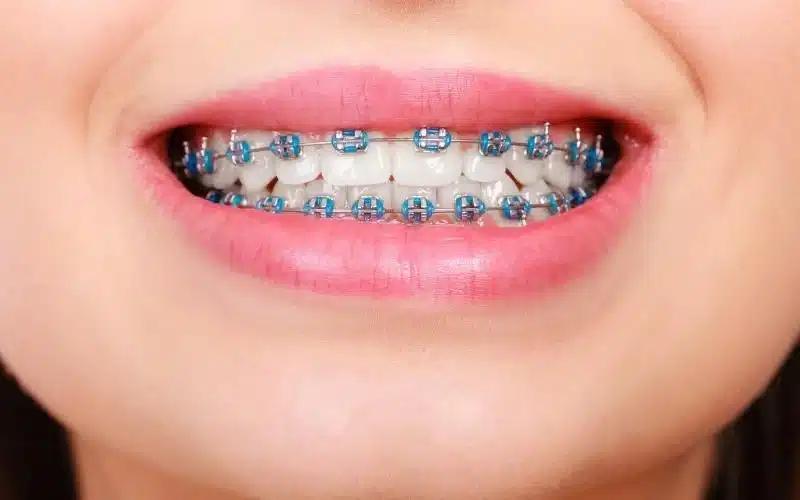 conventional braces